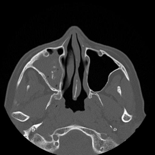 File:Base of skull chondrosarcoma (Radiopaedia 30410-31071 Axial bone window 14).jpg
