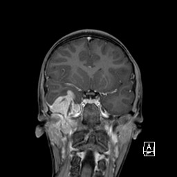 Base of skull rhabdomyosarcoma (Radiopaedia 32196-33142 I 34).jpg