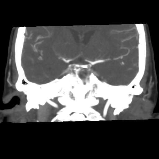 File:Basilar artery fenestration and aneurysms with subarachnoid hemorrhage (Radiopaedia 40066-42573 B 26).png