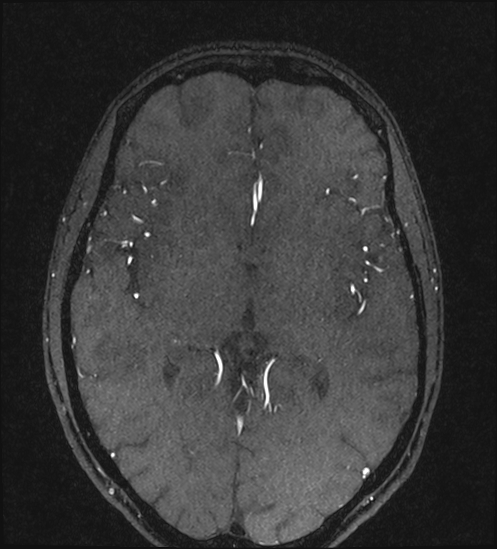 Basilar artery perforator aneurysm (Radiopaedia 82455-97733 Axial MRA 134).jpg