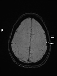File:Basilar artery perforator aneurysm (Radiopaedia 82455-99523 Axial SWI 54).jpg