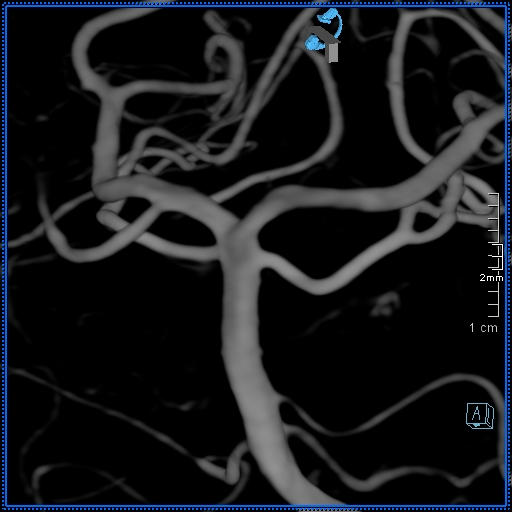 Basilar artery perforator aneurysm (Radiopaedia 82455-99524 3D Left VA 38).jpg