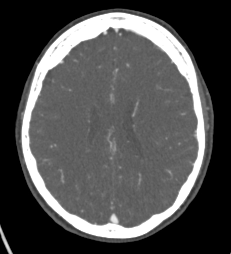 Basilar tip aneurysm with coiling (Radiopaedia 53912-60086 A 97).jpg