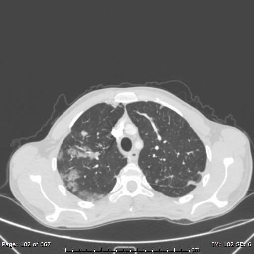 Behçet disease (Radiopaedia 44247-47889 Axial lung window 20).jpg