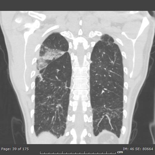 Behçet disease (Radiopaedia 44247-47889 Coronal lung window 8).jpg