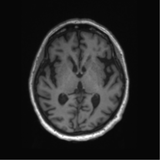 Behavioral variant frontotemporal dementia and late onset schizophrenia (Radiopaedia 52197-58083 Axial T1 51).png