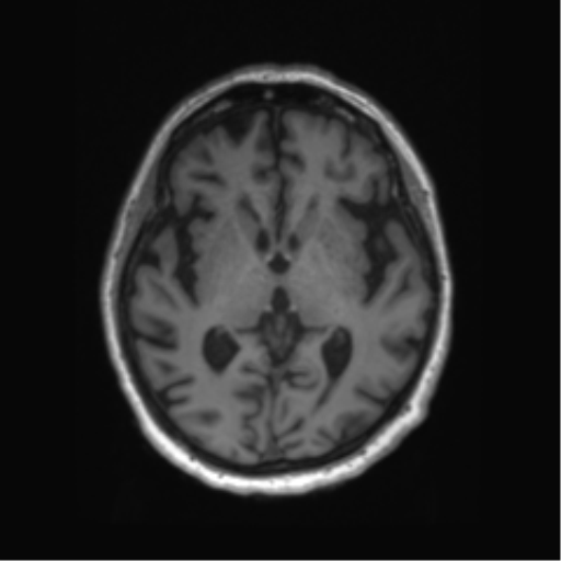 Behavioral variant frontotemporal dementia and late onset schizophrenia (Radiopaedia 52197-58083 Axial T1 52).png