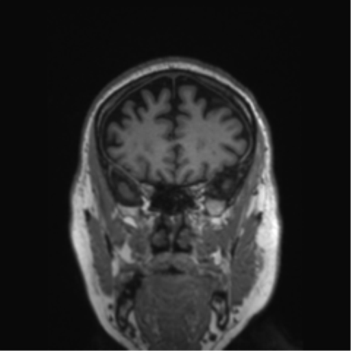 Behavioral variant frontotemporal dementia and late onset schizophrenia (Radiopaedia 52197-58083 Coronal T1 68).png