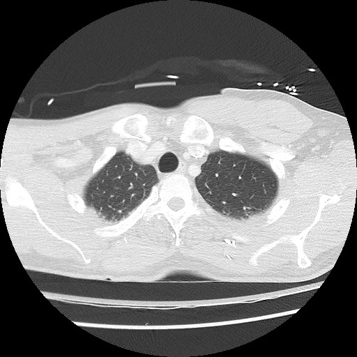 Benign post-traumatic pseudopneumoperitoneum (Radiopaedia 71199-81495 Axial lung window 19).jpg