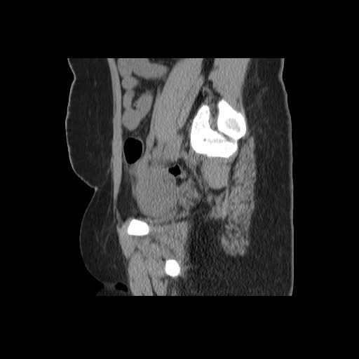 File:Bicornuate uterus- on MRI (Radiopaedia 49206-54296 A 16).jpg