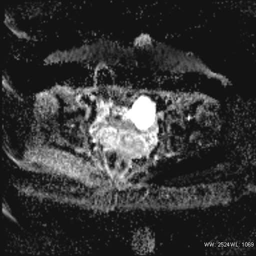 File:Bicornuate uterus- on MRI (Radiopaedia 49206-54297 Axial ADC 16).jpg
