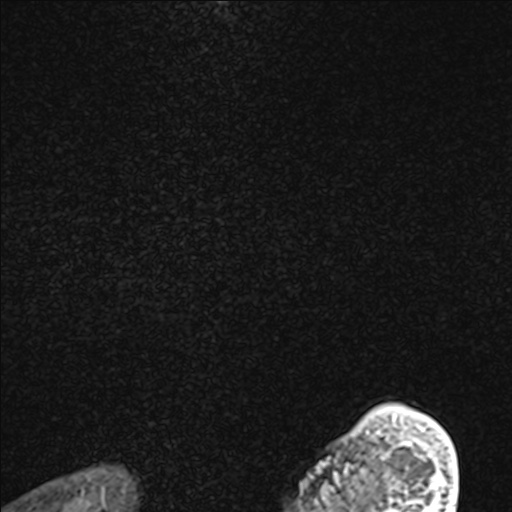 Bilateral Achilles tendon complete tear (Radiopaedia 81344-95051 Sagittal WE - Left 2).jpg