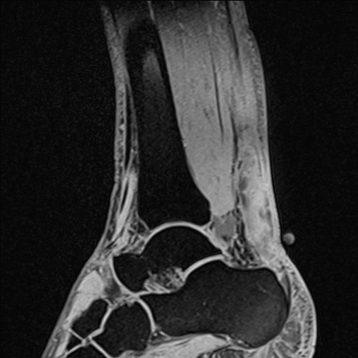 Bilateral Achilles tendon complete tear (Radiopaedia 81344-95051 Sagittal WE - Right 53).jpg