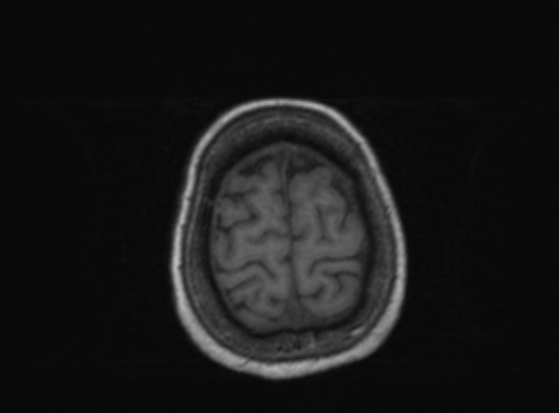 Bilateral PCA territory infarction - different ages (Radiopaedia 46200-51784 Axial T1 137).jpg