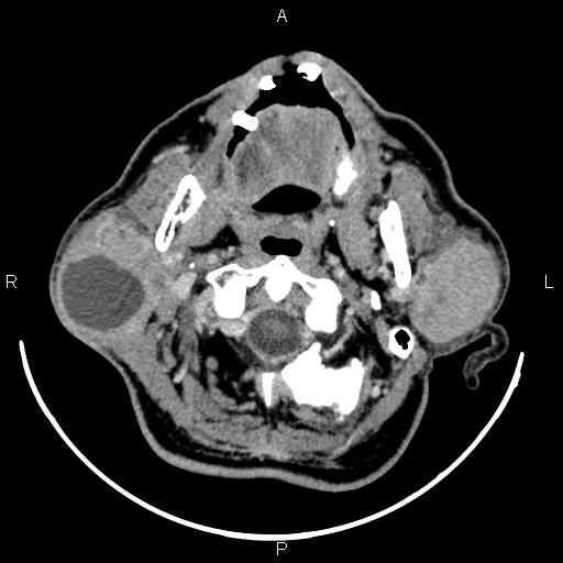 Bilateral Warthin tumors (Radiopaedia 84034-99263 Axial With contrast 19).jpg