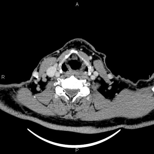 Bilateral Warthin tumors (Radiopaedia 84034-99263 Axial With contrast 44).jpg
