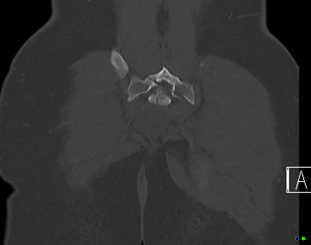 File:Bilateral acetabular fractures (Radiopaedia 79272-92308 Coronal bone window 40).jpg
