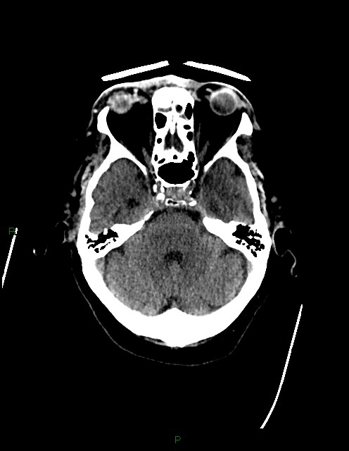 Bilateral acute middle cerebral artery territory infarcts (Radiopaedia 77319-89401 Axial non-contrast 24).jpg