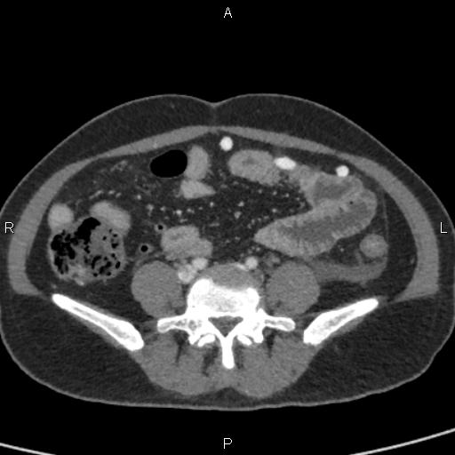 File:Bilateral adrenal gland hyperenhancement in pancreatitis (Radiopaedia 86642-102753 E 76).jpg