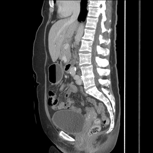 File:Bilateral adrenal granulocytic sarcomas (chloromas) (Radiopaedia 78375-91007 C 71).jpg
