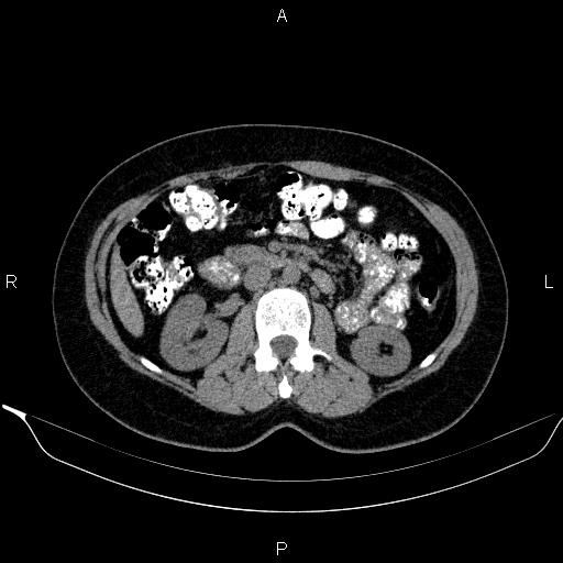 Bilateral adrenal myelolipoma (Radiopaedia 63058-71535 Axial non-contrast 77).jpg