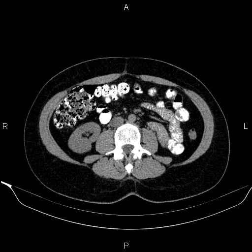 Bilateral adrenal myelolipoma (Radiopaedia 63058-71535 Axial non-contrast 94).jpg
