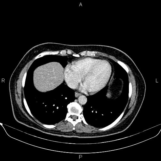 Bilateral benign adrenal adenomas (Radiopaedia 86912-103124 B 10).jpg