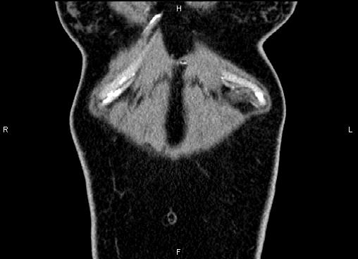Bilateral benign adrenal adenomas (Radiopaedia 86912-103124 D 1).jpg