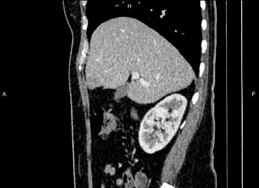 Bilateral benign adrenal adenomas (Radiopaedia 86912-103124 E 28).jpg
