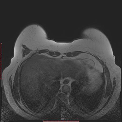 File:Bilateral breast implant rupture (Radiopaedia 24761-25027 T1 32).jpg