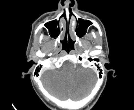Bilateral carotid body tumors (Radiopaedia 61841-69870 Axial Post contrast 5).jpg