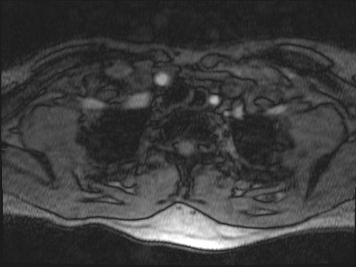 Bilateral carotid body tumors and right glomus jugulare tumor (Radiopaedia 20024-20060 Axial MRA 182).jpg