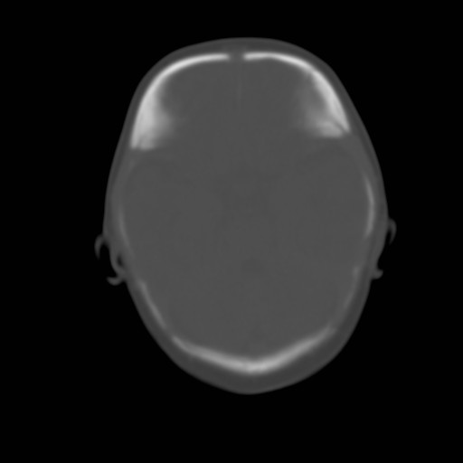 File:Bilateral cephalohematomas and subdural hematomas (Radiopaedia 26778-26929 Axial bone window 5).jpg