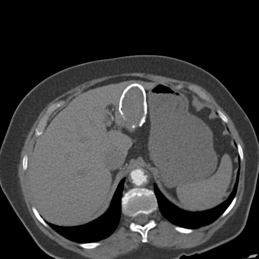 File:Bilateral delayed nephrogram from renal artery stenosis (Radiopaedia 47681-52362 A 12).png