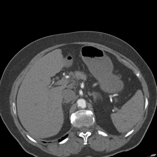 File:Bilateral delayed nephrogram from renal artery stenosis (Radiopaedia 47681-52362 A 17).png