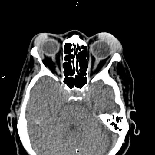 Bilateral enlargement of lacrimal glands - sarcoidosis (Radiopaedia 62627-70921 Axial non-contrast 47).jpg