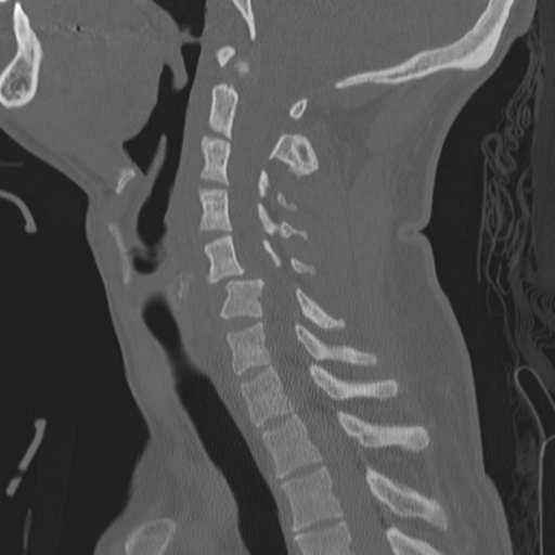 Bilateral locked facets (Radiopaedia 33850-35016 Sagittal bone window 26).png