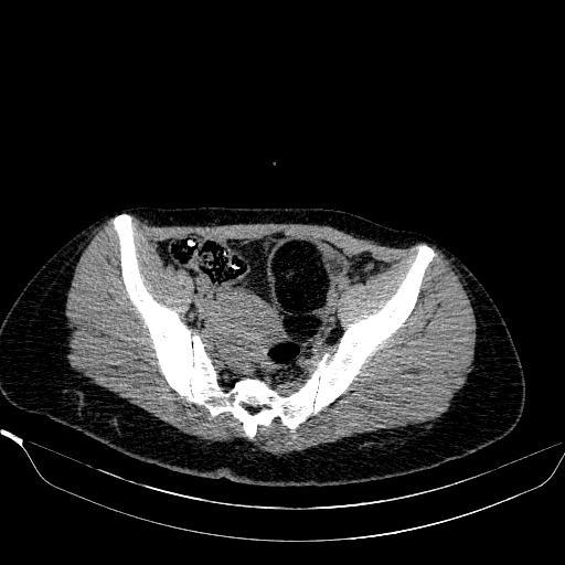 File:Bilateral ovarian dermoid (Radiopaedia 45714-49907 Axial non-contrast 21).JPEG