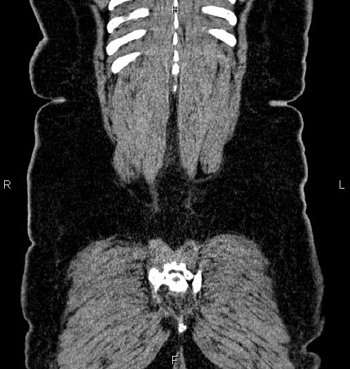 File:Bilateral ovarian dermoid cysts (Radiopaedia 85785-101603 C 59).jpg