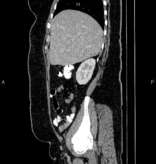 File:Bilateral ovarian dermoid cysts (Radiopaedia 85785-101603 D 18).jpg