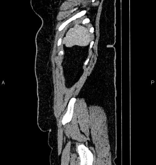 Bilateral ovarian dermoid cysts (Radiopaedia 85785-101603 D 89).jpg
