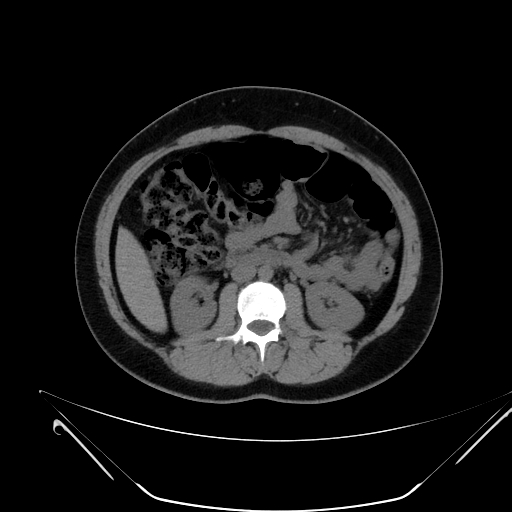 Bilateral ovarian mature cystic teratomas (Radiopaedia 79373-92457 Axial non-contrast 27).jpg