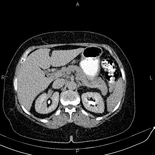 Bilateral ovarian serous cystadenocarcinoma (Radiopaedia 86062-101989 Axial C+ delayed 13).jpg