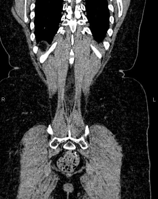 Bilateral ovarian serous cystadenocarcinoma (Radiopaedia 86062-101989 D 50).jpg