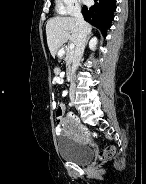 Bilateral ovarian serous cystadenocarcinoma (Radiopaedia 86062-101989 E 35).jpg
