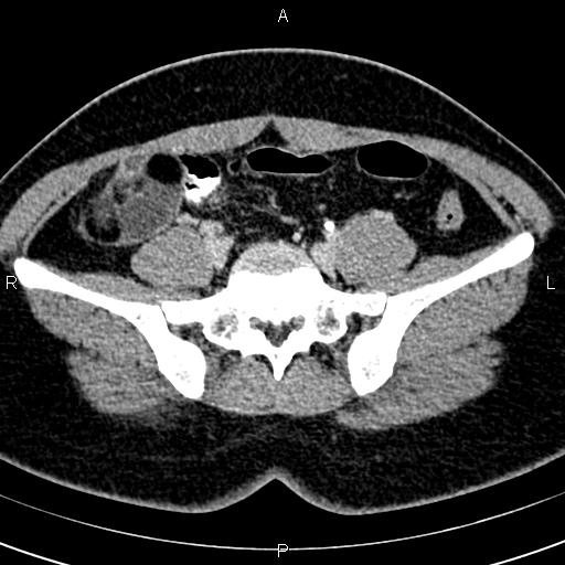 Bilateral ovarian teratoma (Radiopaedia 83131-97503 B 18).jpg