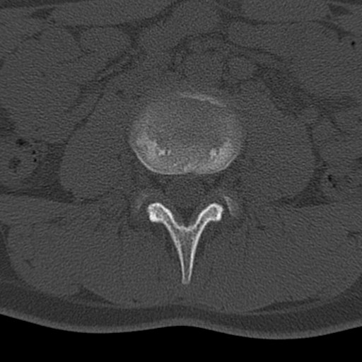 Bilateral pars defect (Radiopaedia 26691-26846 Axial bone window 11).jpg