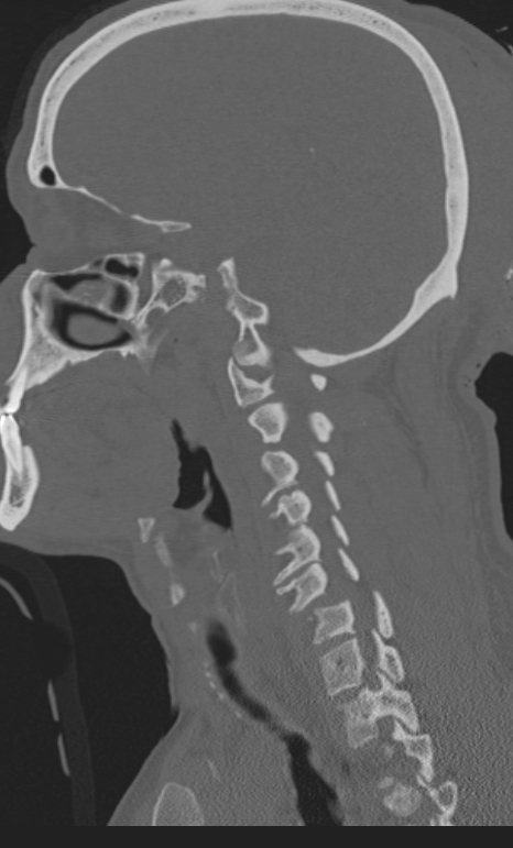 Bilateral perched facet joint (Radiopaedia 63149-71669 Sagittal bone window 45).jpg