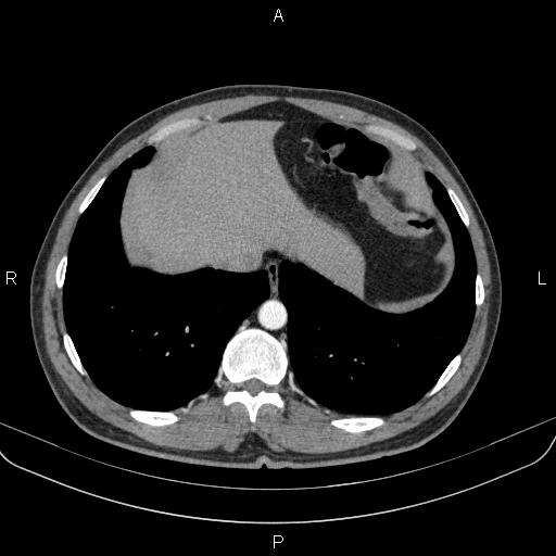 File:Bilateral pulmonary AVM (Radiopaedia 83134-97505 A 60).jpg