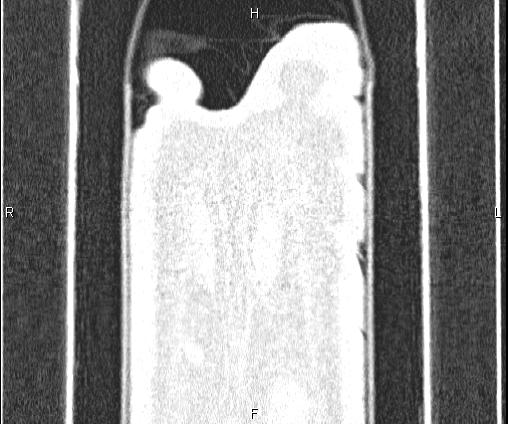 File:Bilateral pulmonary AVM (Radiopaedia 83134-97505 Coronal lung window 84).jpg